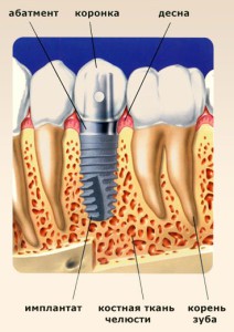 зубной имлантат